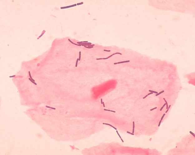 Fialové tyčinkovité laktobacily na růžové buňce z vaginálního stěru pod mikroskopem